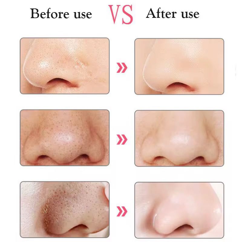 Black heads removal