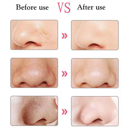 Black heads removal